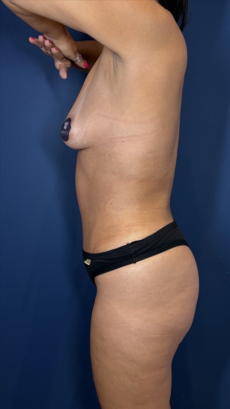 Depois da cirurgia