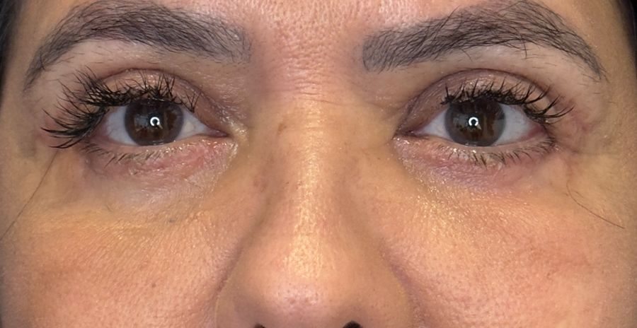 Depois da cirurgia